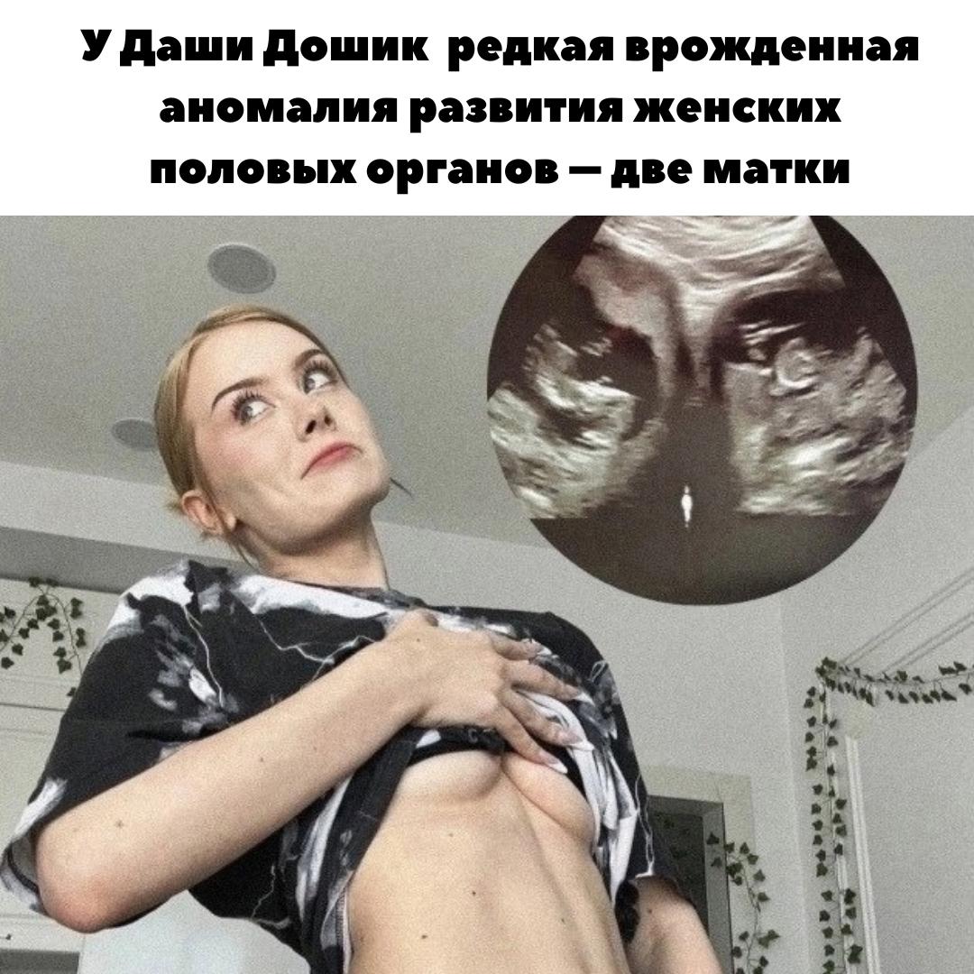 "У МЕНЯ ДВЕ МАТКИ" &#128551; Блогер Даша Дошик шокировала поклонников заявление